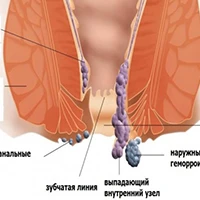 Лікування ГЕМОРОЮ народними методами